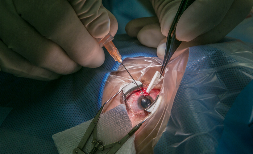 ICL Implantable Collamer Lens Surgery