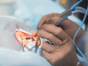 Advanced Phaco Technology